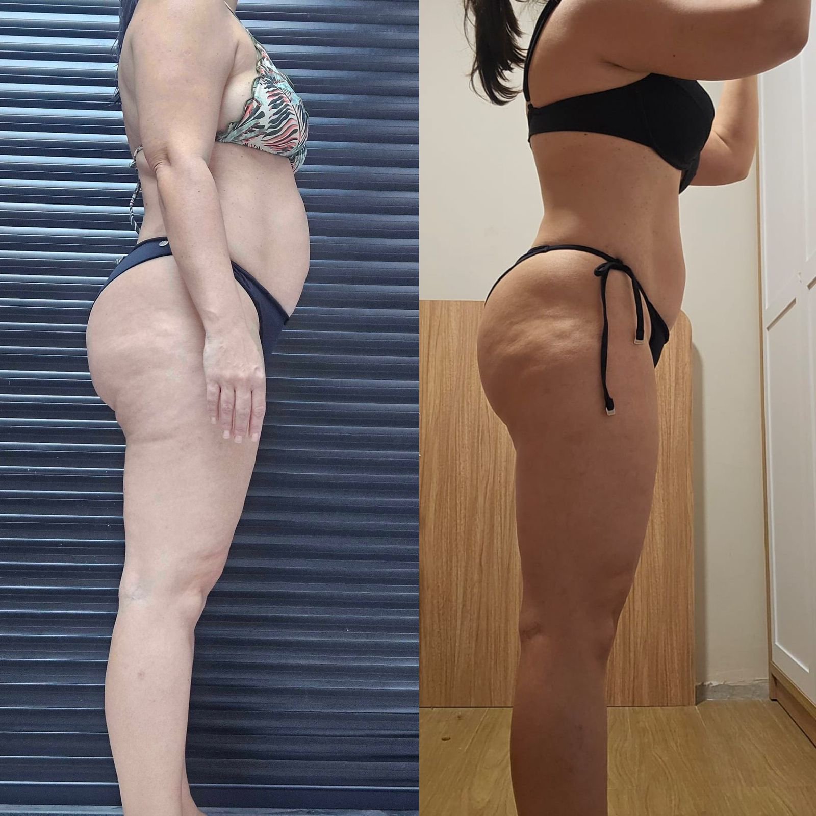 Transformação feminina - redução de celulite e definição